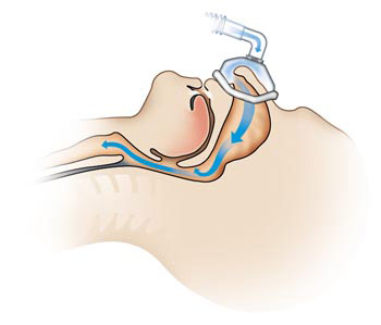 Corrected Open Airway Breathing with CPAP